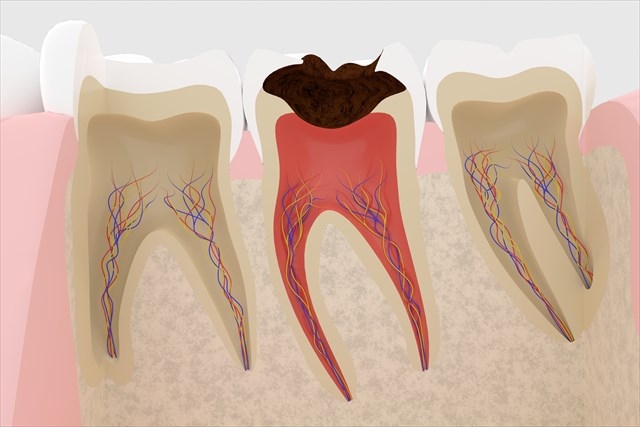 虫歯治療画像